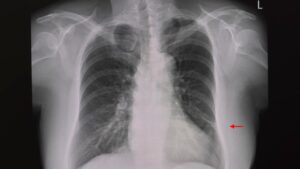 Questa condizione può passare inosservata o colpire gravemente chi ne soffre. Atelettasia: sintomi e cause