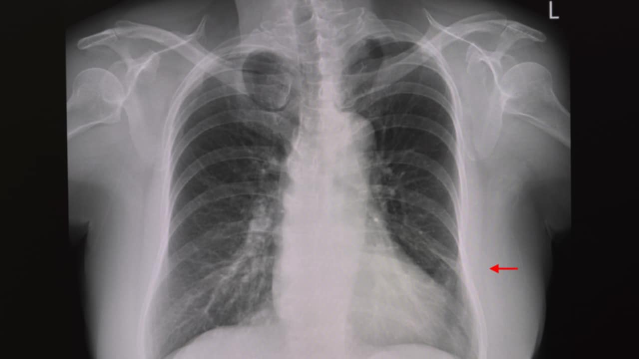 atelettasia sintomi e cause