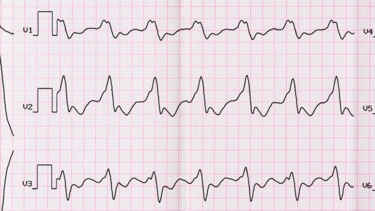 sintomi fibrillazione atriale