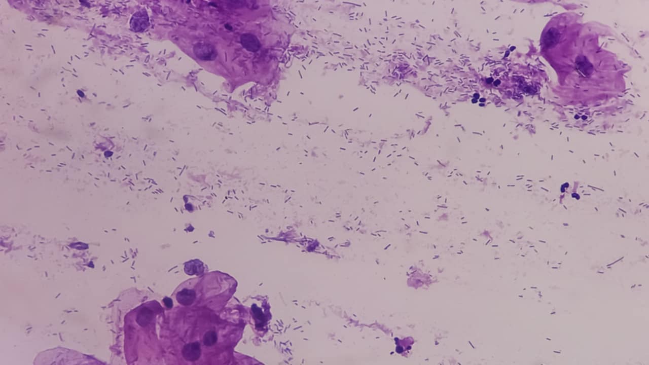 gestione fibromi uterini