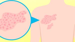 Questa malattia può essere causata dallo stress, non tutti lo sanno!