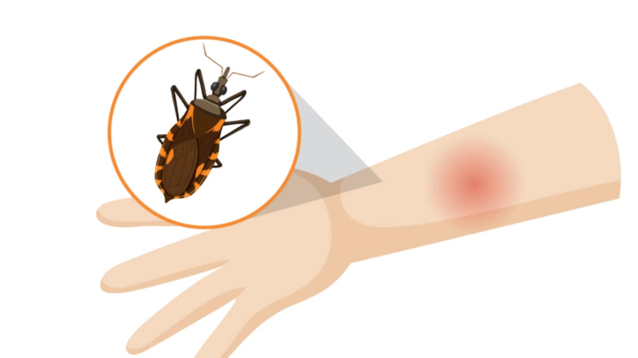 cimice morbo di Chagas