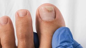 Cos’è l’onicolisi e come trattarla