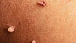 Fibromi penduli: quando preoccuparsi e soprattutto cosa sapere