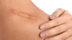 Formidabili rimedi naturali per ridurre quella cicatrice che non ti piace: migliora l’estetica della tua pelle