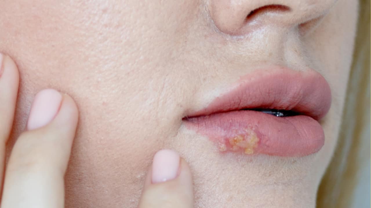 puntini bianchi labbra