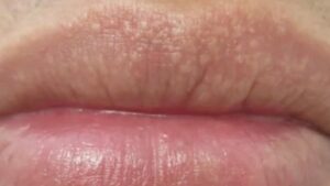 Cosa sono quei puntini bianchi sulle labbra? Le cause che devi conoscere