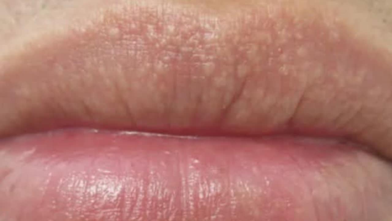 puntini bianchi labbra