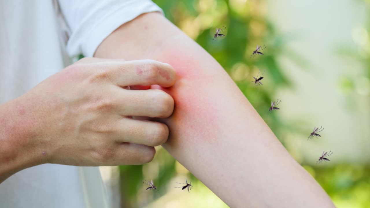 rimedi punture di zanzara 