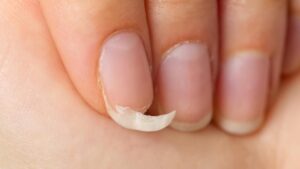 ATTENZIONE: la carenza di ferro può causare questi sintomi