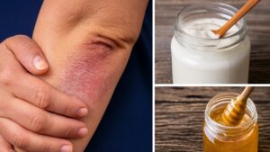 Come preparare 5 soluzioni naturali per i funghi sulla pelle