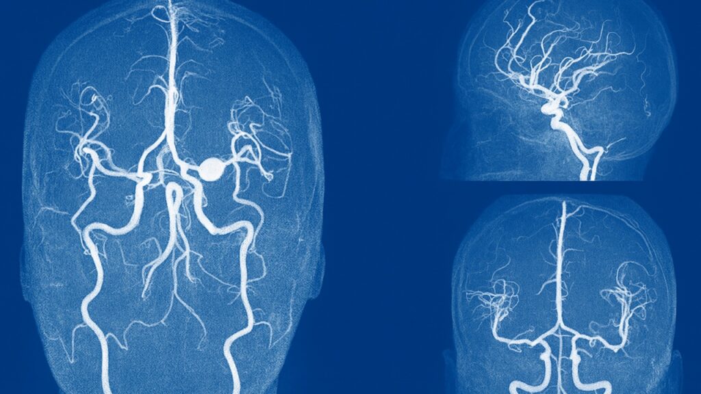 aneurisma al cervello