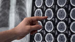 Come prevenire un ictus seguendo questi 6 consigli