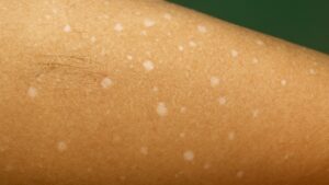 Cosa c’è dietro queste macchie bianche sulla tua pelle? Cause possibili che dovresti conoscere