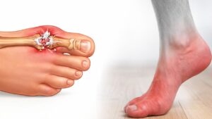 9 cibi che devi mangiare per tenere sotto controllo i tuoi livelli di acido urico