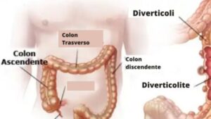 I sintomi della diverticolite e cosa fare per migliorare la tua salute intestinale