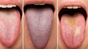 Quello che la tua lingua può dirti sulla tua salute