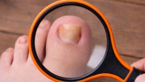 Sbarazzati delle unghie incarnite con questi 6 trucchetti