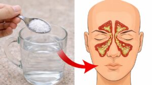 10 rimedi naturali contro le infezioni del seno paranasale: allevia la sinusite facilmente