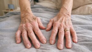 Artrite reumatoide: gli alimenti da evitare