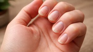 I sintomi della carenza di ferro che non dovresti assolutamente ignorare