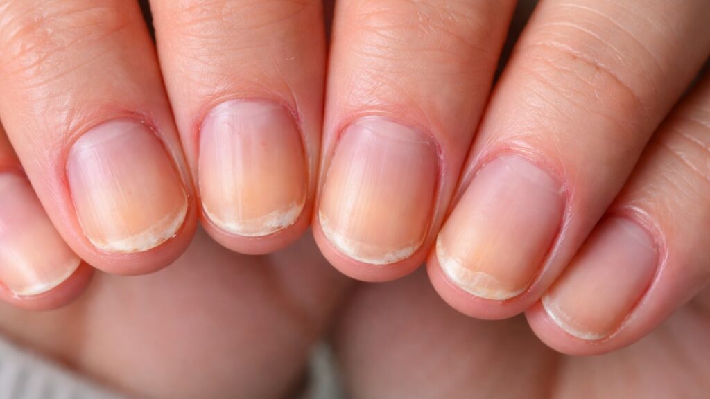 unghie fragili